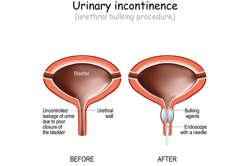 How Assisted Living In Charlotte, NC, Can Help Seniors With Incontinence Problems