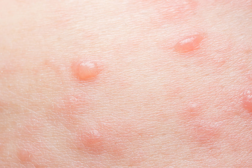 How Seniors Can Prevent Impetigo While Living In A Senior Community In Huntersville, NC