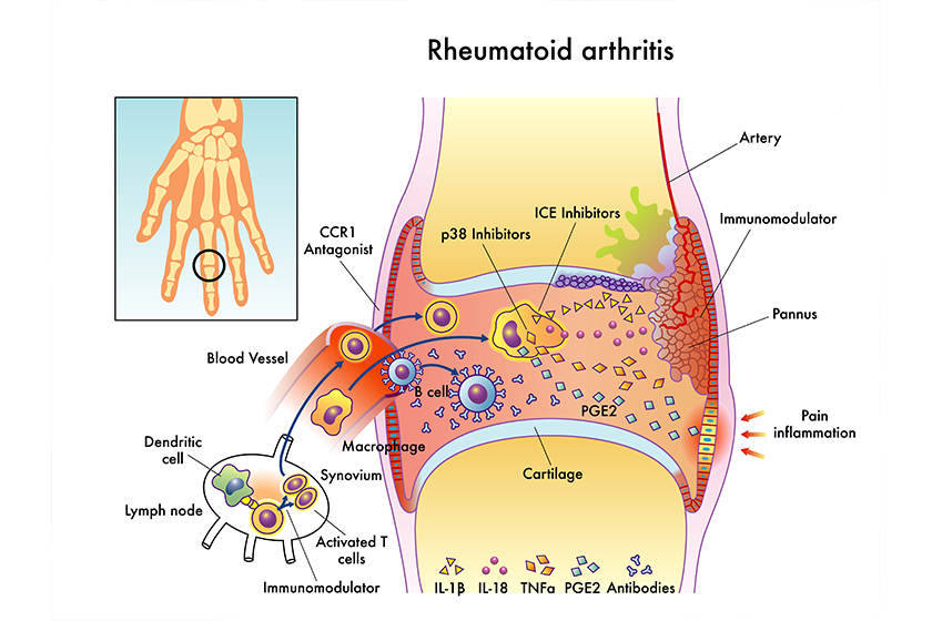 How Rheumatoid Arthritis Can Be Managed In Retirement Communities In Charlotte, NC